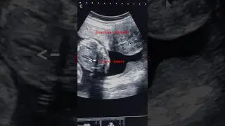 Uterine fibroid and pregnancy | uterine fibroid during pregnancy |#obglife #pregnancy #ytshorts