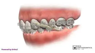 How Class II Elastics Work | Correcting Overjet and Bite Alignment