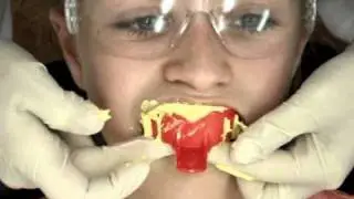 Impressions For Upper TPA West London Orthodontist