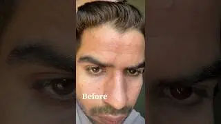 Tretinoin cream that kriti sanon using #tretinoin #tretinoincream #kritisanon #darkspots #acne