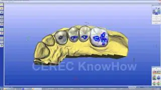 CEREC&reg; Bridge Biogeneric   - Bridge - Software