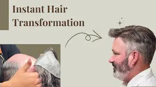 A Modern Solution for Hair Loss