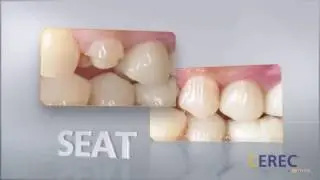 Cerec patient video
