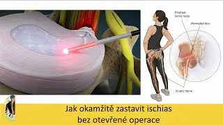 Jak okamžitě zastavit ischias bez otevřen&eacute; operace (Laserov&aacute; l&eacute;čba PLDD)