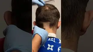 Balding Clipper vs Trimmer