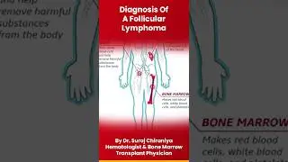 Diagnosis of Follicular Lymphoma by @Dr.SurajChiraniya-Hematologist #lymphoma #bloodcancer #cancer