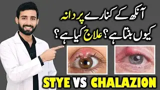 Stye eye or Chalazion|Aankh ke palak par Dana|Stye Eye Natural Home Remedies #stye 