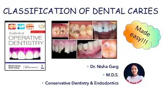 DENTAL CARIES | G.V. BLACK'S CLASSIFICATION | MADE EASY