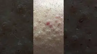 Let's Count Acnes - ACNE TREATMENT MAI NGOC FAMILY 💕💕 - ACNE TREATMENT MAI NGỌC - demo