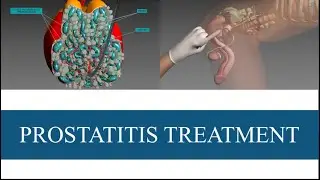 Prostatitis Treatment (Georgiadis Protocol Pressure) | Prostatitis & STIs