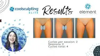 CoolSculpting Before & After Inner Thighs | Element Body Lab | Dallas, Tx