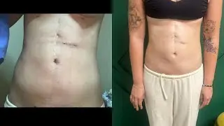 Behind the Scenes: Fibrosis Prevention Case with Bianca
