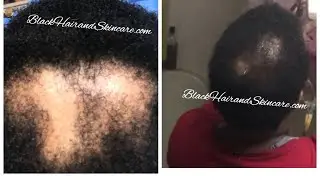 Updated Client Reviews and Alopecia Success Story&rsquo;s ! (BlackHairandSkincare.com) (Pics Included)