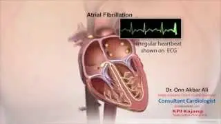 Normal Heart Rhythm and Atrial fibrillation
