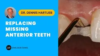 Replacing the Missing Anterior Tooth | Dental Online Training