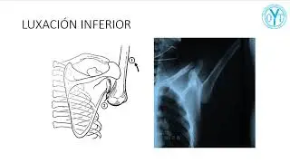 Técnicas de reducción de luxación inferior y posterior de hombro
