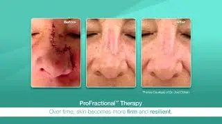 Resurfacing Perfected Overview