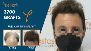 🌟 Απίστευτη Διαφορά με FUE Μεταμόσχευση Μαλλιών: Ο Γιώργος έχει Αυτοπεποίθηση ξανά! 💇‍♂️ Case #235