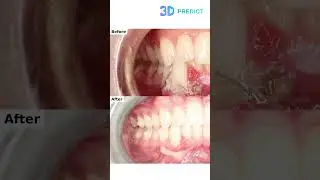 3D Predict: orthodontic software that delivers predictable results🚀