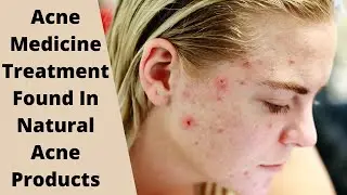 Acne Medicine Treatment Found In Natural Acne Products