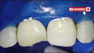 ¡Transformación Increíble! Resina Anterior Estética con Microscopio Dental