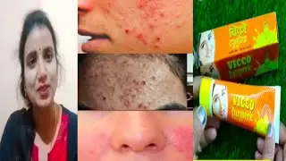 Vicco turmeric cream side effect //गर्मियों मे आप Vicco खरीदना चाहते हैं तो इस video को जरूर देखें
