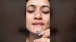 Pimple removal hack 😱😳 #youtubeshorts #shorts