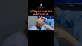 4630 graft Transplant with micro FUE method #fueclinic #hairlosscure #skincare #hairenhancement