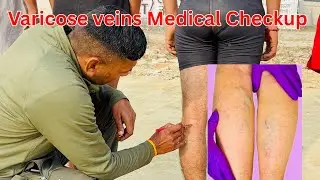 INDIAN ARMY AGNIVEER Varicose Veins Medical Test Bharti 2026 All Physical-Ravi Fauji 