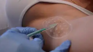 BOTOX For Sweaty Armpits |  Beverly Hills