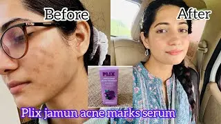 How I got rid of my acne marks by using just Plix Jamun 10% Niacinamide Serum|Sakshi Nagar #skincare