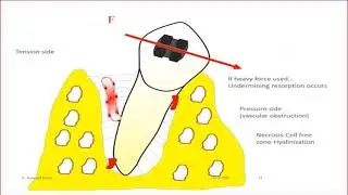 Tissue Changes in Orthodontic Tooth Movement