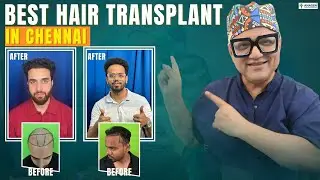 Best Hair Transplant in Chennai | Real Before After Results | Expert Hair Transplant Clinic