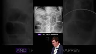 Small bowel perforation and ischemia