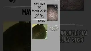 Stop Hair Loss with Eiko All Natural Products #haircare #organic #hairproducts #hairlossawareness