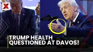 Trump Bruised Hands: President Trump addresses hand bruise questions publicly| NewsX World