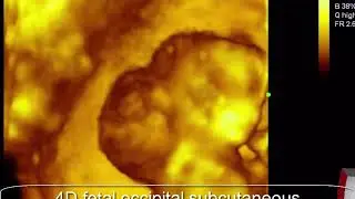 CASE 483 fetal occipital subcutaneous hygroma 4D ultrasound
