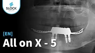 [EN dub / RU sub] AllonX - 5