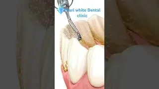 Get your teeth scaling done with pearl white Dental clinic #nangaldam_dentist #toothdoctor #smile
