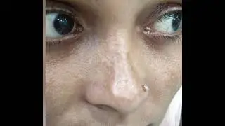 MELASMA 