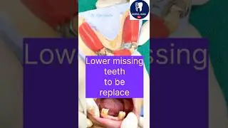 OralHealthmanagement #replace missing teeth with a cast partial don&rsquo;t ever extract healthy teeth🙏🏻