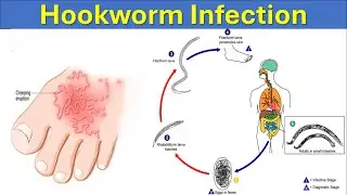 Hookworm Infections: How Ancylostoma duodenale Affects Human Health | Life Cycle Explained
