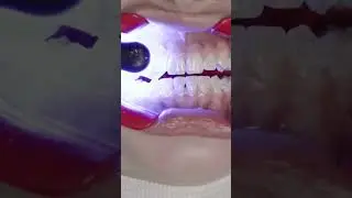 LightForce braces being put on 🤯 3D printed indriect bonding trays make this process fast! #braces
