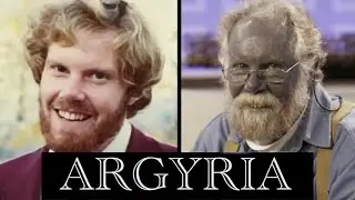 Argyria Medical Condition Caused By Ingested Colloidal Silver | The Blue Man | Silver Nanoparticles