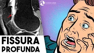 FISSURA CONDRAL PROFUNDA: O que significa?