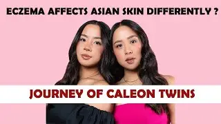 ECZEMA AFFECTS ASIAN SKIN DIFFERENTLY ! || JOURNEY OF CALEON TWINS WITH SKIND CONDITION !