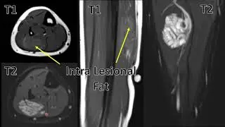 Soft Tissue Cavernous Hemangioma Case Presentation