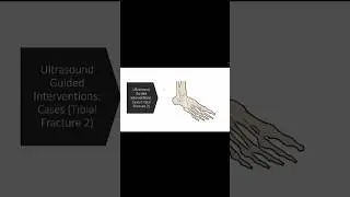 #ultrasound Guided Interventions: Cases (Tibial Fracture 2) #sportsmedicine #sports #fyp