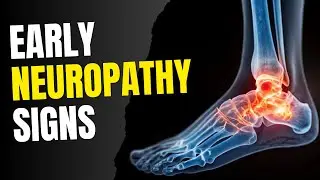 Early Neuropathy Signs: Catch This Before It's Permanent