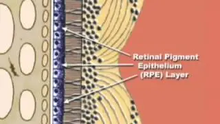 Dry Macular Degeneration - Eye Associates of Colorado Springs